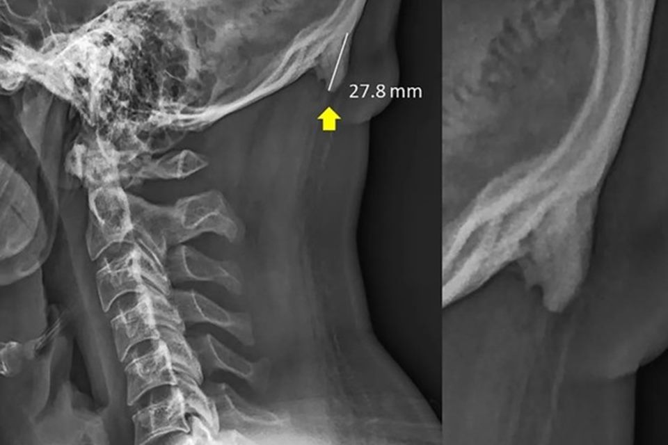 41% dos raios-x pesquisados apresentaram um crescimento anormal de ossos na parte de baixo do crânio